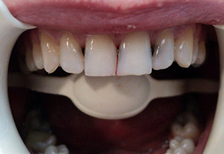 Фото 1. Восстановление зубов