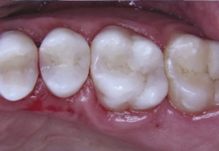 Фото 3. Восстановление жевательных зубов