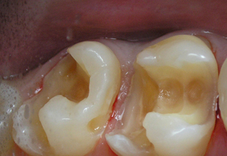 Фото 4. Восстановление жевательных зубов