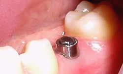 Имплантация зубов. Фото 3