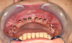 Имплантация зубов. Фото 7