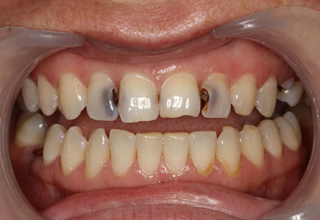 Пример 1. Кариес зубов