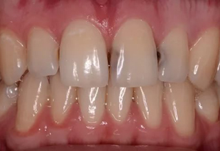 Пример 5. Кариес зубов