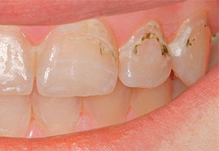 Пример 6. Кариес зубов