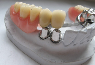 Фото 3. Cъемные зубные протезы