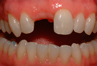 Фото 6. Имплантация передних зубов
