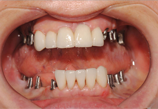 Фото 3. Установка зубных имплантов