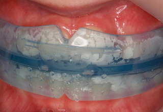 Фото 6. Выравнивание зубов без брекетов
