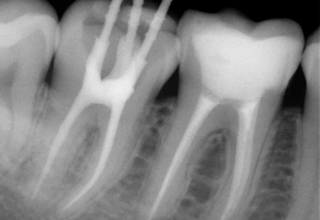 Фото 4. Лечение каналов зуба