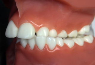Ортодонтическое лечение в стоматологии Москвы
