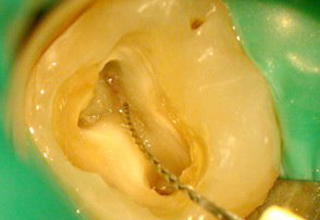 Фото 6. Лечение каналов зуба под микроскопом