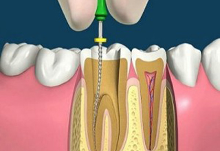 Чистка зубных каналов. Фото 3