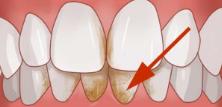 Коренные зубы у детей: симптомы прорезывания