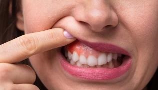 Почему чешутся зубы или между зубами у взрослого человека