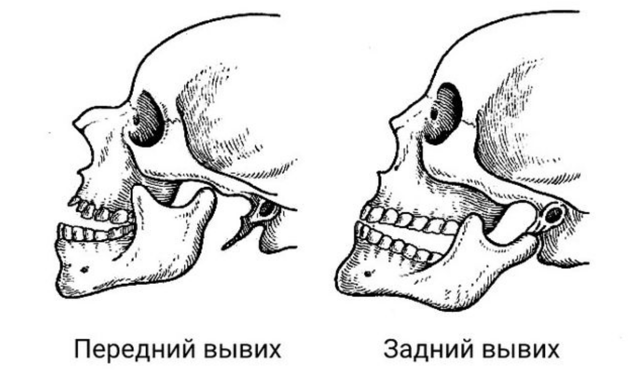 Оскольчатый перелом