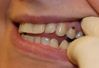 Кариес корня зуба — причины, симптомы, диагностика, лечение и цены