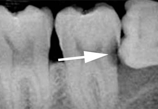 Кариес корня зуба - что это, лечение, диагностика