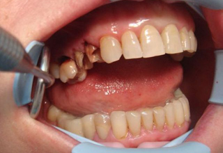 Причины образования кариеса корня зуба