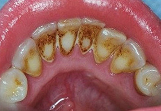 Зубной камень: причины образования и методы удаления