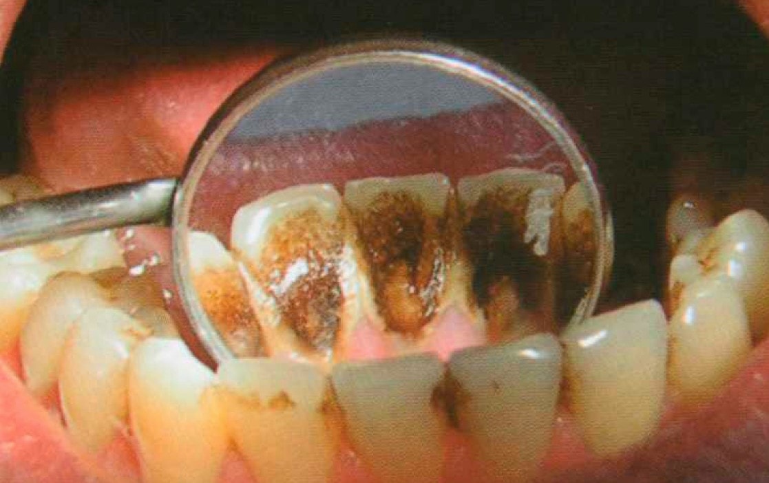 На зубах черный налет: причины возникновения, способы очистки и рекомендации по уходу