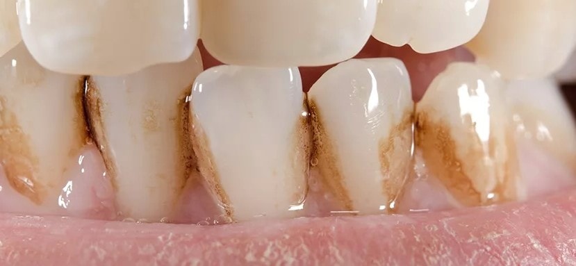 Как размягчить и удалить зубной камень в домашних условиях