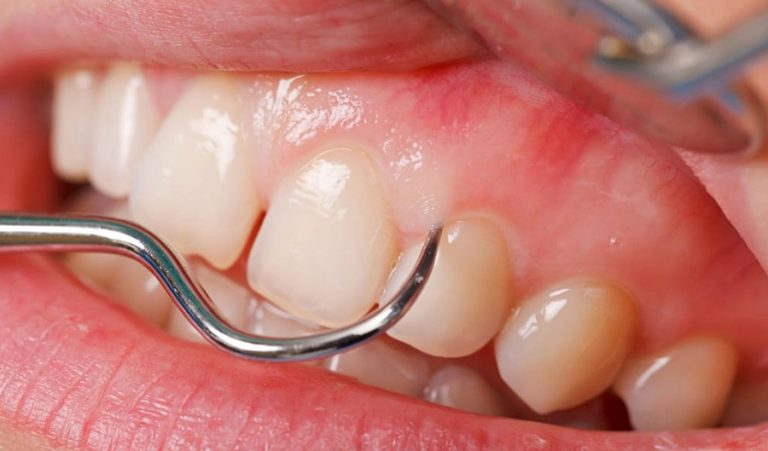 Флюс зуба: причины возникновения, симптоматика и методы лечения