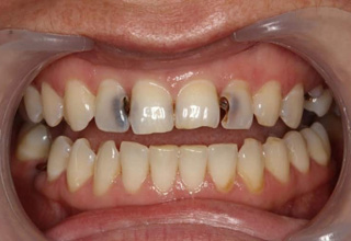 Черные зубы у детей