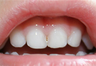 Особенности лечения зубов у маленьких детей