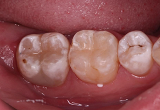 Разрушаются зубы: причины и меры противодействия крошению и ломкости