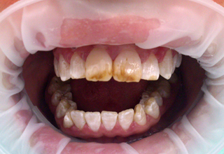 Темные пятна на зубах: причины появления и способы избавиться