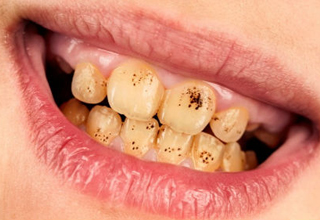 О чем могут свидетельствовать коричневые пятна на зубах