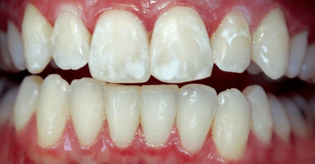 Причины флюороза зубов