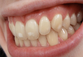 Почему появляются меловидные пятна на зубах