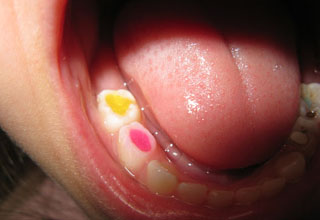 Почему пульсирует зуб без нерва?