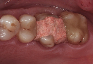 Болит зуб после установки временной пломбы