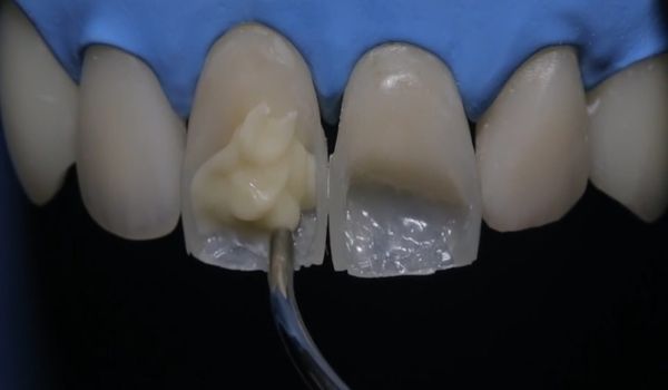 Возможна ли установка виниров на запломбированные зубы?