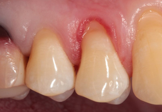 Клиновидный дефект зубов: почему развивается и как лечат