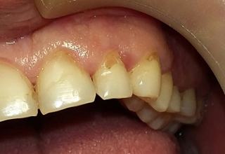 Лечение зубов в домашних условиях