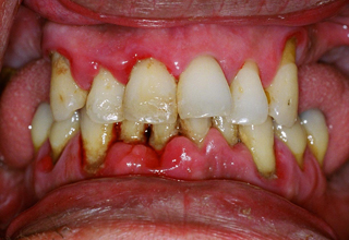 Воспаление полости рта (стоматит): причины, виды заболеваний и методы лечения