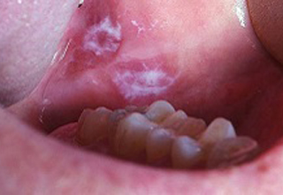 Заболевания полости рта и десен
