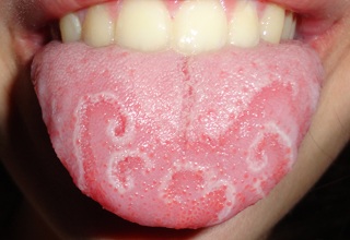 Лечение травмы слизистой полости рта и языка