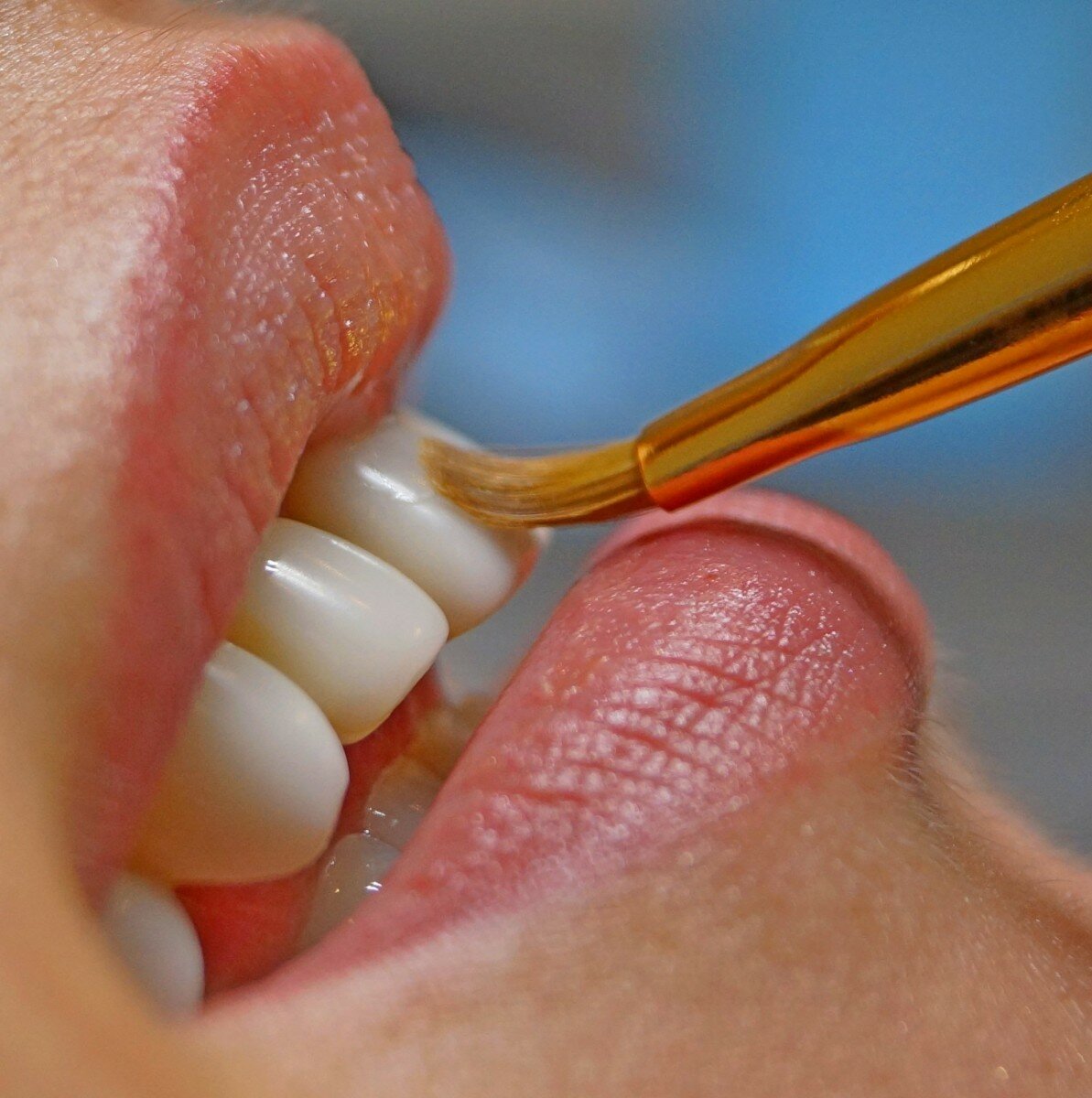 Как выглядит клиновидный дефект зуба