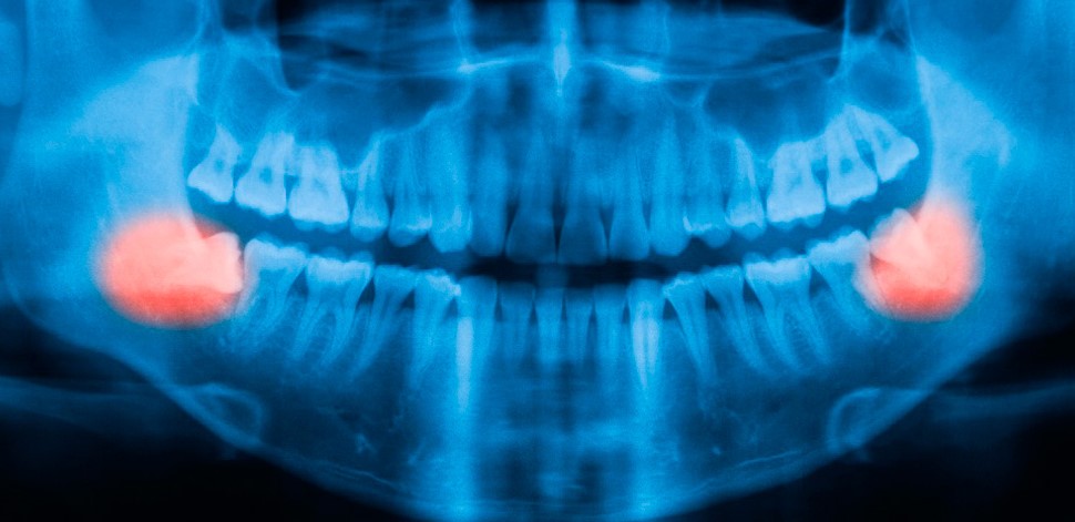 Что такое ретинированный зуб мудрости фото