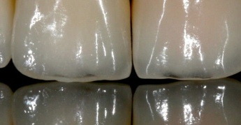 прозрачные зубы фото