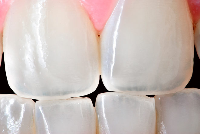 прозрачные зубы передние зубы