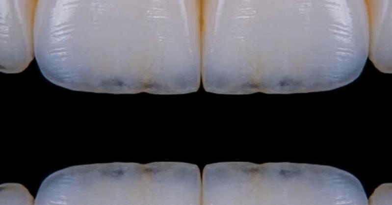 прозрачные зубы
