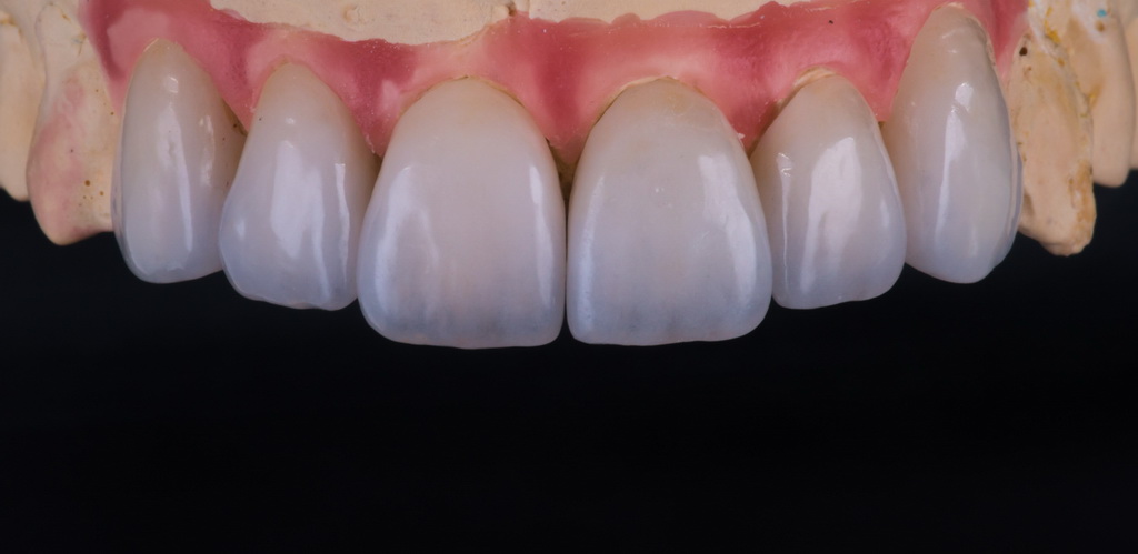 Почему зубы прозрачные - 7 причин, 1 решение