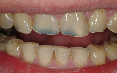 Прозрачные зубы: причины и способы лечения