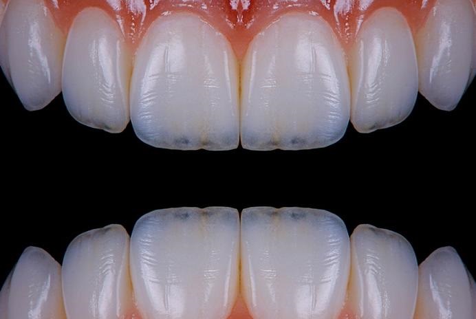 Повышенное истирание зубов: причины, признаки, лечение