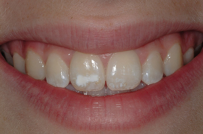 гипоплазия эмали зубов фото